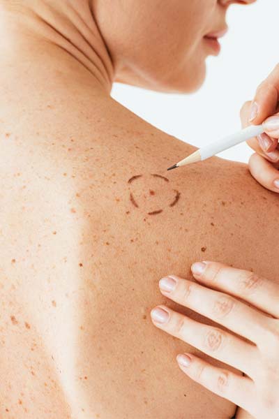 Surveillez vos grains de beauté : Quand consulter un dermatologue ?